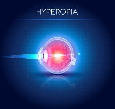 Hyperopia eyesight disorder Stock Illustration