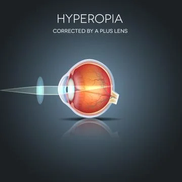 Hyperopia Illustrazione stock