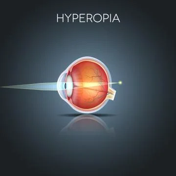 Hyperopia Stock Illustration