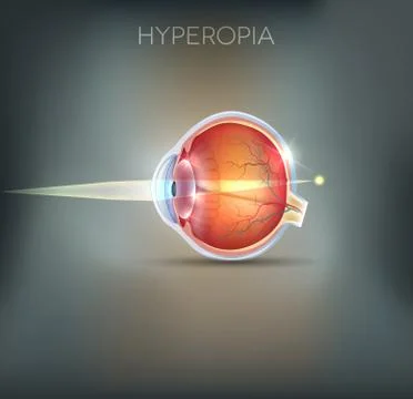 Hyperopia Stock Illustration