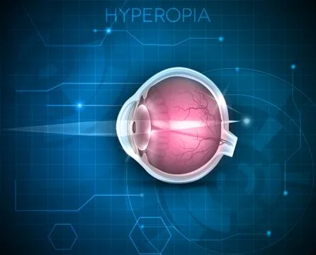 Hyperopia Stock Illustration