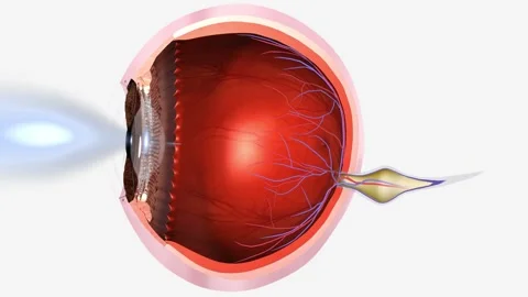 Hyperopia, or farsightedness, is a vision condition in which distant objects are Video stock 246056174