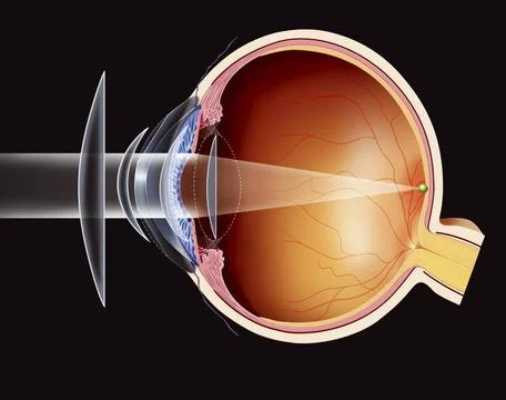  Hyperopia treatment, drawing Hypermetropic eye - the different possible c... Stock Photos