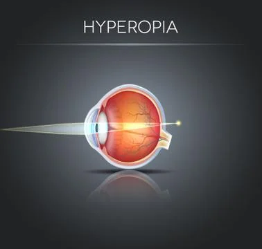 Hyperopia, vision disorder Stock Illustration