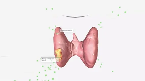 Hyperparathyroidism is a condition in which high amounts of parathyroid hormone Stock Footage 231402163