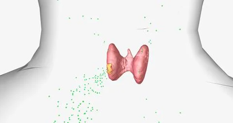 Hyperparathyroidism is a condition in which high amounts of parathyroid hor.. Stock Illustration