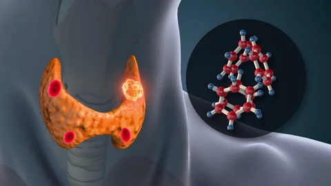 Hyperparathyroidism Disorder Affecting Human Body Hormones Stock Footage 317535625