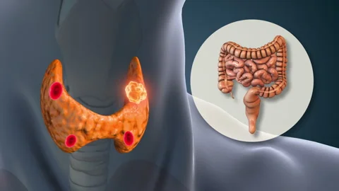 Hyperparathyroidism Stimulating Small Intestine Calcium Absorption Stock Footage 317433894