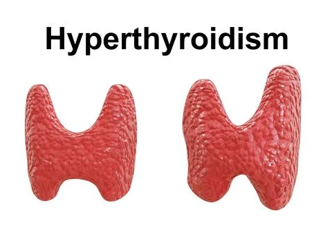 Hyperthyroidism is characterized by an abnormal enlargement of the gland, cau Stock Illustration