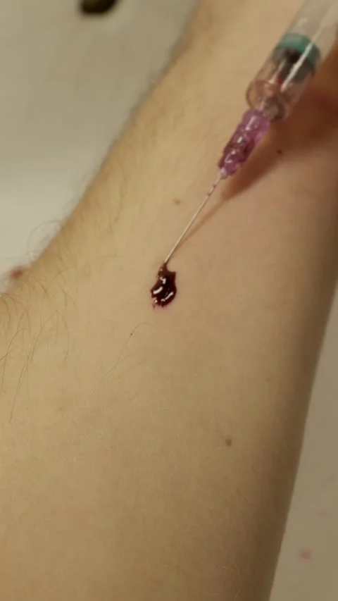 Hypodermic Needle Withdrawing From Arm With Visible Blood Drop Stock-Footage 330276149