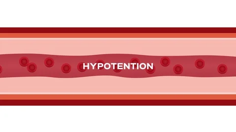 Hypotention text Stock Footage 93875561