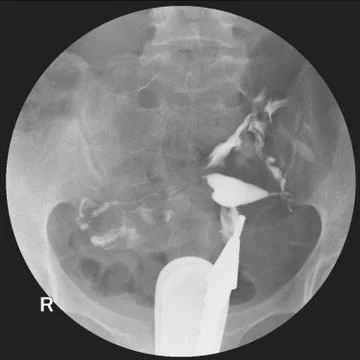 Hysterosalpingography is a type of X-ray called fluoroscopy that looks at a w Stock Photos