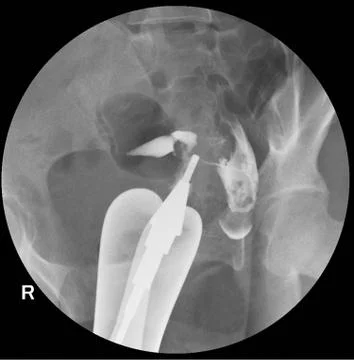 Hysterosalpingography is a type of X-ray called fluoroscopy that looks at a w Stock Photos