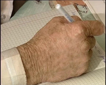 Ichthyosis Stockbeeldmateriaal 1340545