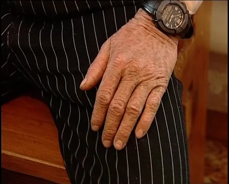 Ichthyosis Видео 1340551