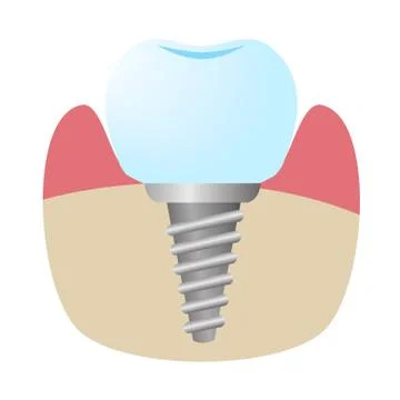 Icon of the implant installed in the bone in the section. Stock Illustration