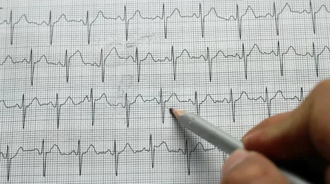 Identifying electrocardiogram 스톡 동영상 36473971