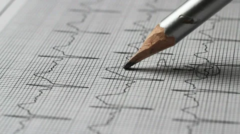Identifying waves of an electrocardiogram Video stock 36476529