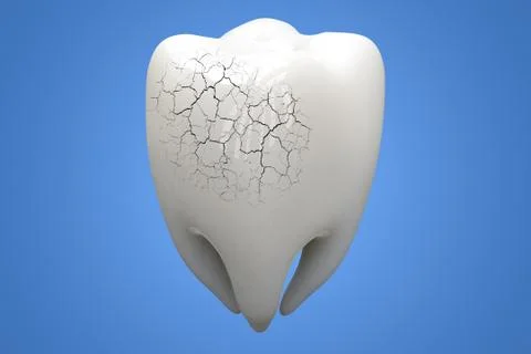 Illness Tooth on blue background. 3d illustration Illustrazione stock