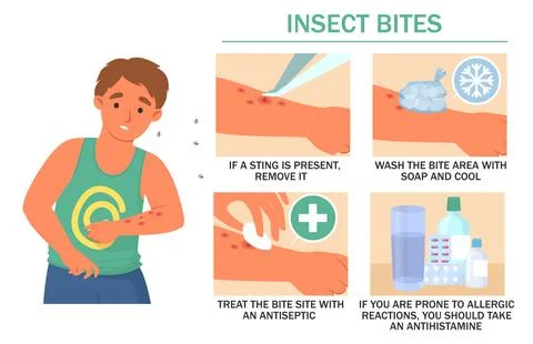 Illustrated steps for treating insect bites show how to remove stings, clean the Illustrazione stock