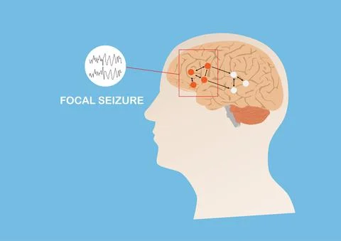 Illustration of abnormal electrical activity causing focal seizure. Stock Illustration