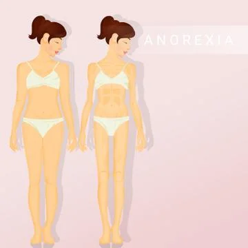 Illustration of anorexia Illustrazione stock