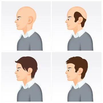 Illustration of baldness Stock Illustration