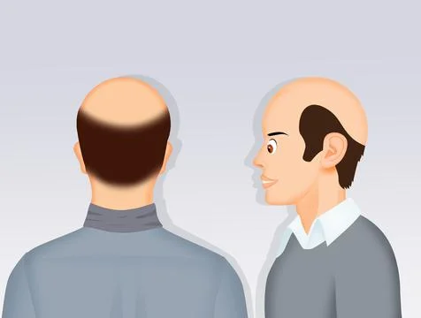 Illustration of baldness Stock Illustration