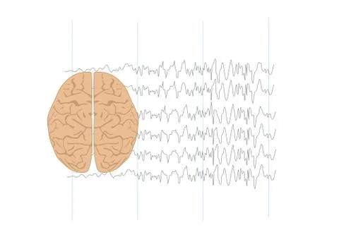 Illustration of brain and abnormal brain waves Stock Illustration