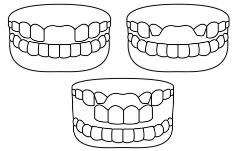 Illustration of a bridge over a missing front tooth, simple line drawing Stock Illustration