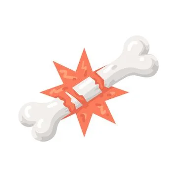 Illustration of Broken Bone Stock Illustration