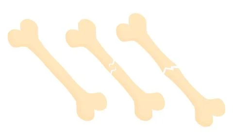 Illustration of broken bones and normal bones redesign Stock Illustration