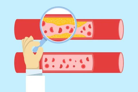 Illustration of cardiovascular system analysis, showing cholesterol buildup. Stock Illustration