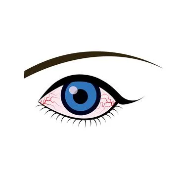 Illustration of the eye disease. conjunctivitis Stock Illustration