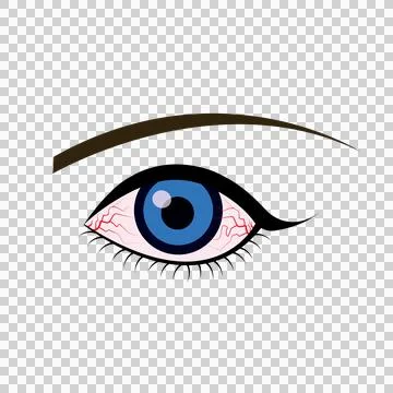 Illustration of the eye disease. conjunctivitis Stock Illustration