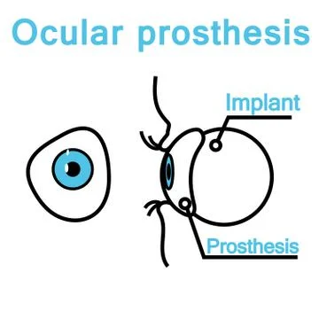 Illustration of an eye prosthesis Stock Illustration