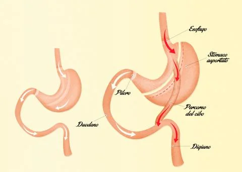 Illustration of gastric bypass Stock Illustration
