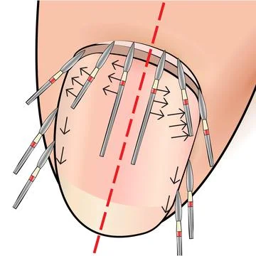 Illustration with hardware manicure technology. Correct position of the cutter Illustrazione stock