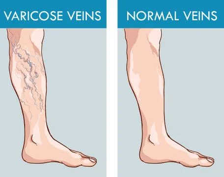 Illustration of a healthy leg and the affected varicose veins Stock Illustration