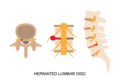 Illustration of herniated lumbar disc in different view. Stock Illustration