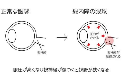 Illustration of how glaucoma works, normal and glaucomatous eyes, medical Stock Illustration