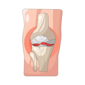 Illustration of Knee joint Illustrazione stock