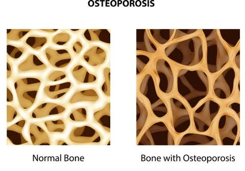 Illustration of normal bone and bone with osteoporosis Stock Illustration