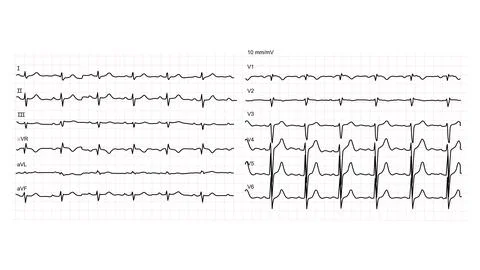Illustration of normal electrocardiogram on white background. イラスト素材