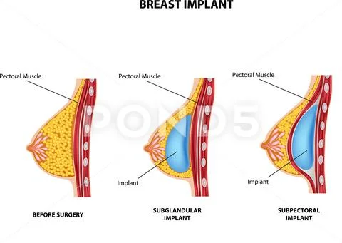 Breast plastic surgery.Vector Illustration. Stock Vector