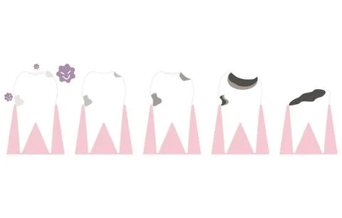Illustration of progress of tooth decay Stock Illustration