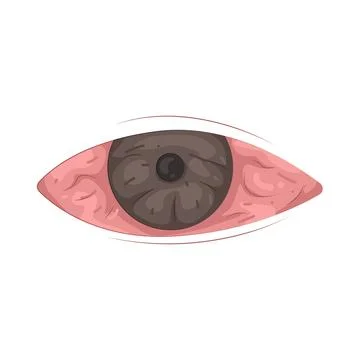 Illustration of Red eye Stock Illustration