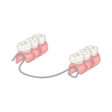 Illustration of removable partial denture Illustrazione stock