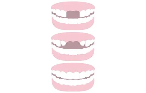 Illustration set of teeth bridging the missing front teeth 스톡 일러스트
