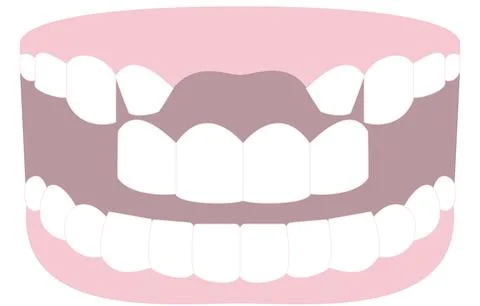 Illustration of a tooth bridging the missing front tooth Stock Illustration